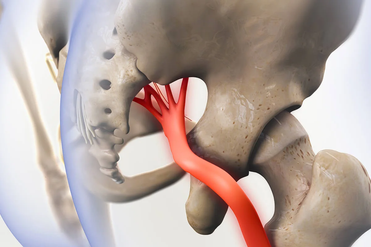 What Causes Sciatica?
