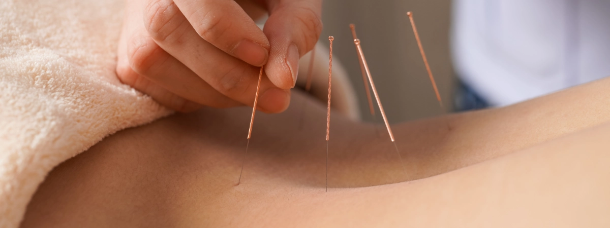 acupuncture-in-west-loop