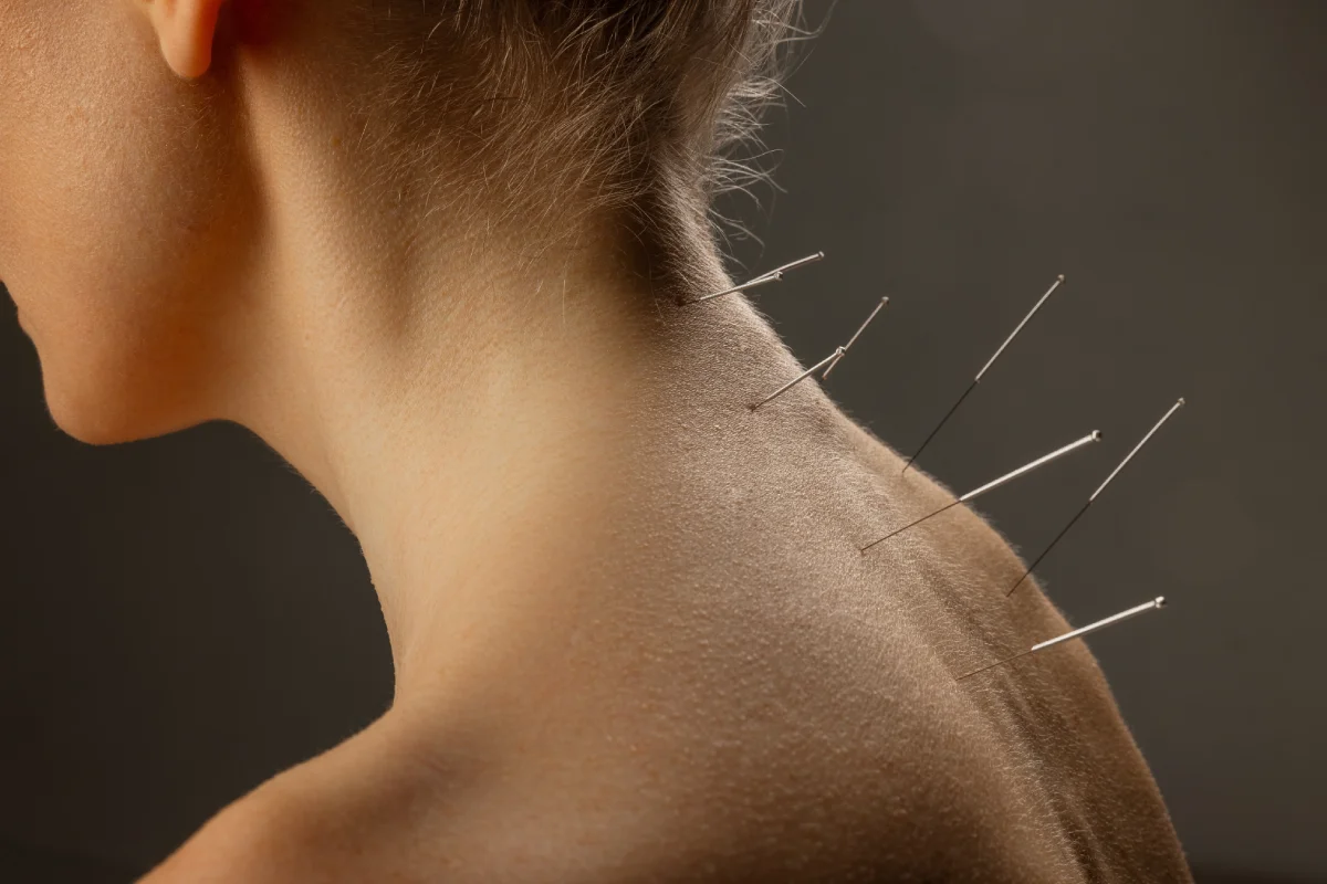 Why Turn to Us for Acupuncture in West Loop, Chicago, IL